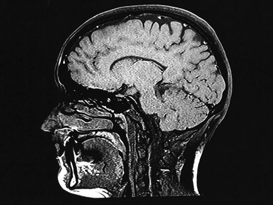 Signs Of Minor Brain Injuries