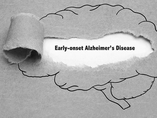 What Is Early-Onset Alzheimers?