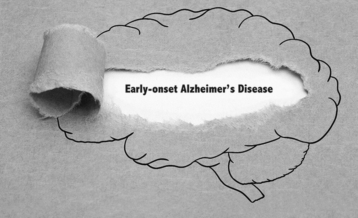 What Is Early-Onset Alzheimers? What Is Early-Onset Alzheimers?
